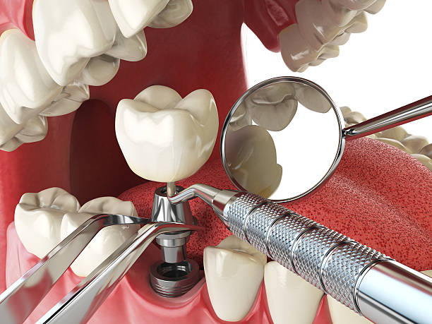 Best Emergency Dental Care for Broken or Chipped Teeth in Wheeling, WV